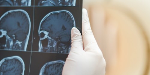 Diagnosing Multiple Sclerosis With Magnetic Resonance Imaging (MRI)